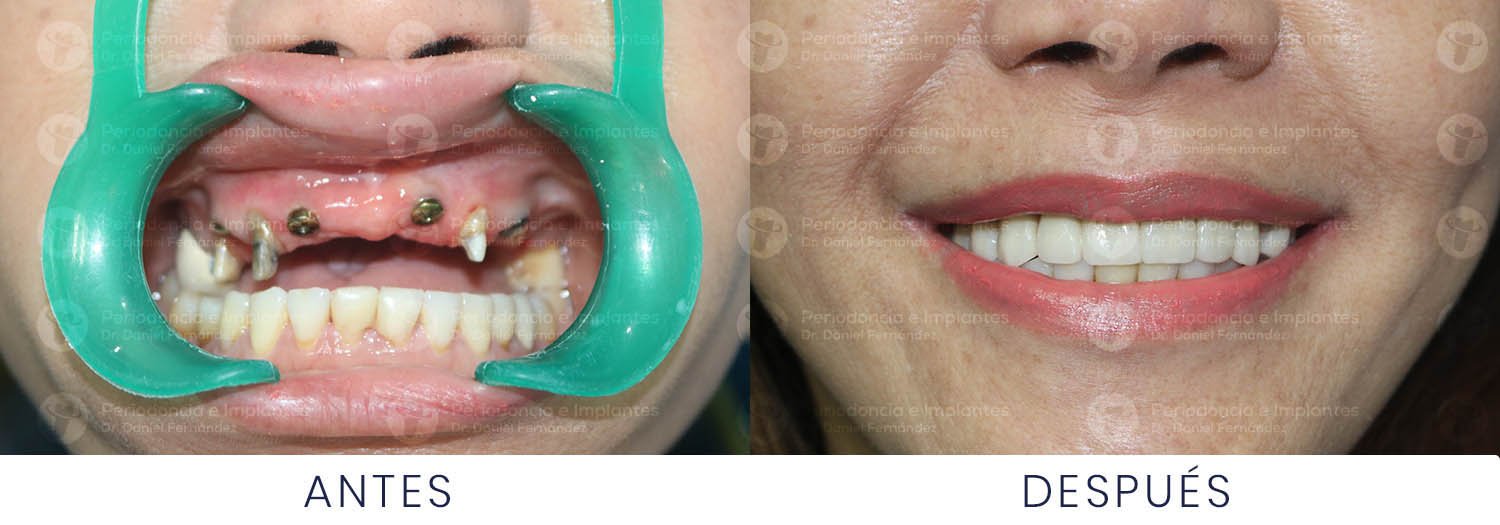 dr-daniel-fernandez-periodoncista-implante-dental-antes-despues-caso-1