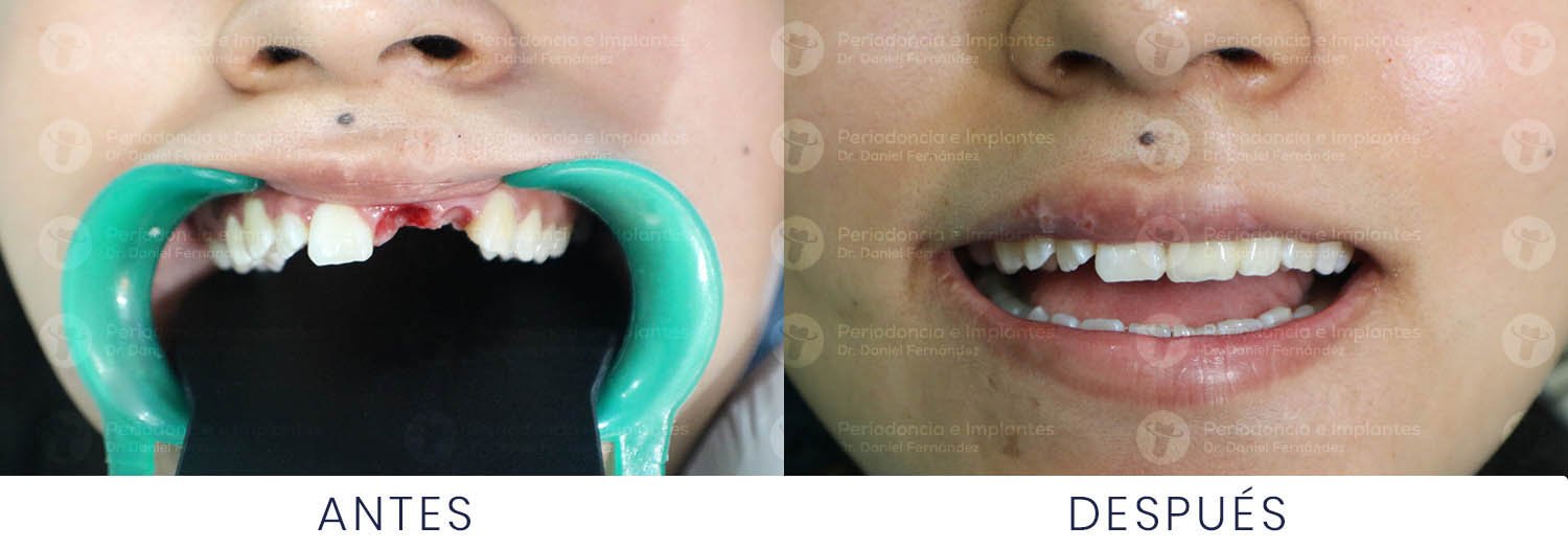 dr-daniel-fernandez-periodoncista-implante-dental-antes-despues-caso-2