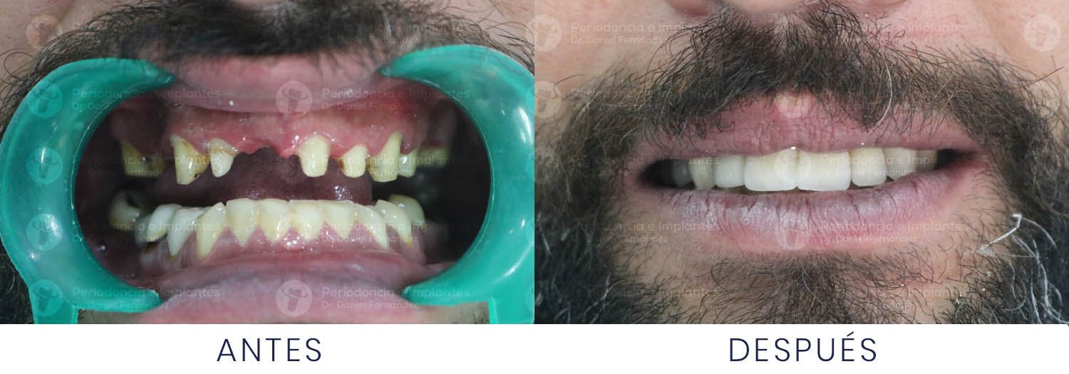 dr-daniel-fernandez-periodoncista-implante-dental-antes-despues-caso-3