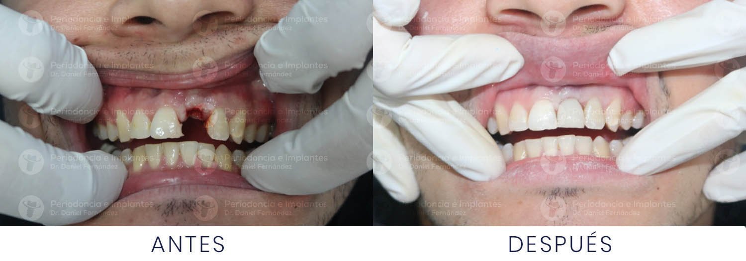 dr-daniel-fernandez-periodoncista-implante-dental-antes-despues-caso-4