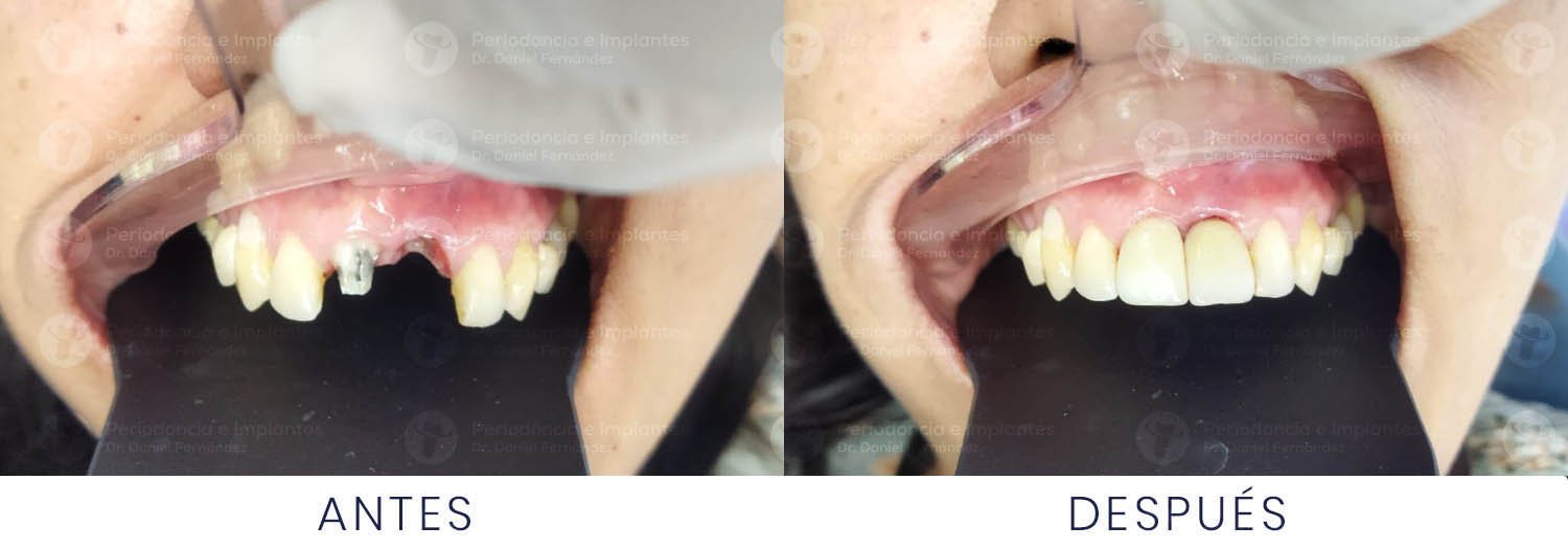 dr-daniel-fernandez-periodoncista-implante-dental-antes-despues-caso-5