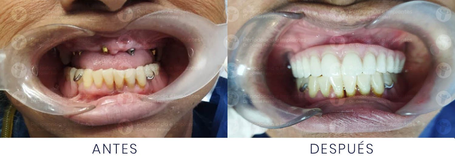 dr-daniel-fernandez-periodoncista-implante-dental-antes-despues-caso-6