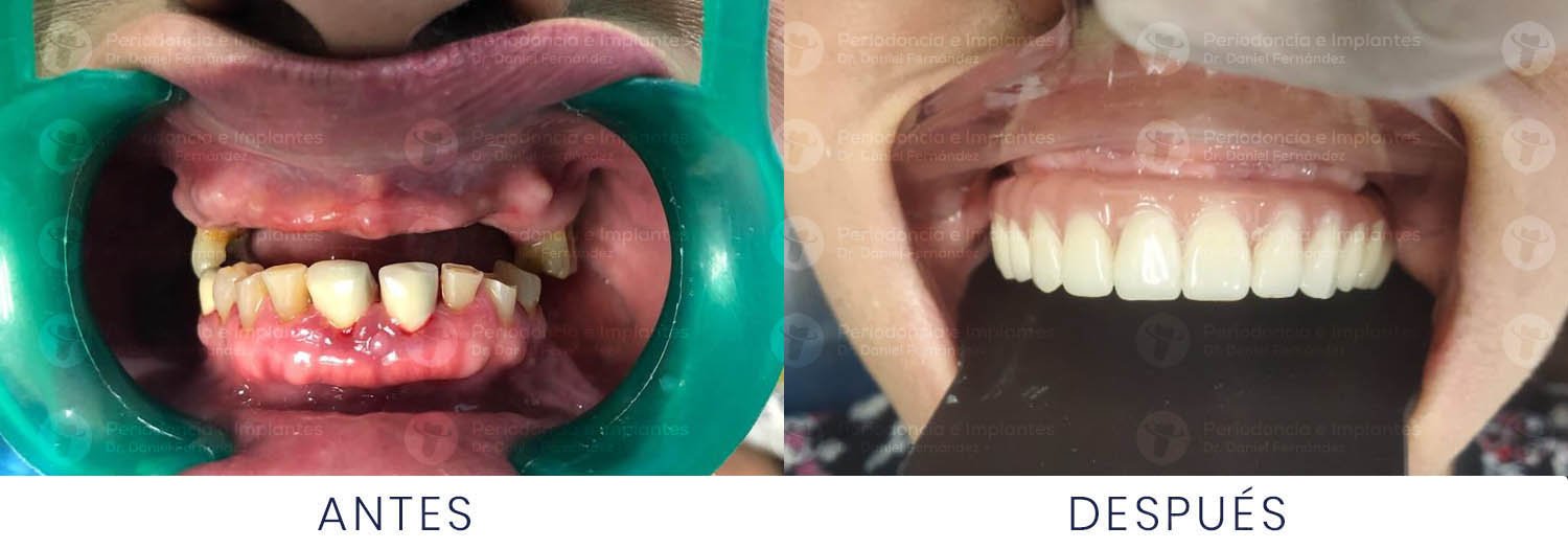 dr-daniel-fernandez-periodoncista-implante-dental-antes-despues-caso-7
