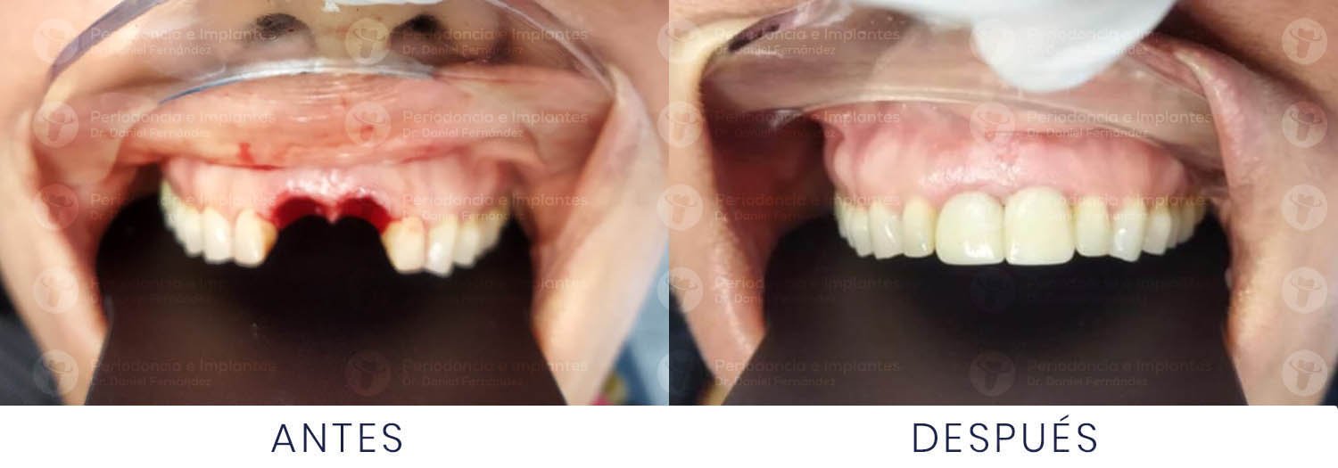 dr-daniel-fernandez-periodoncista-implante-dental-antes-despues-caso-8